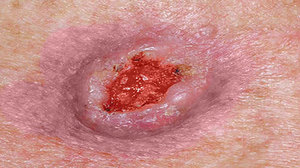 Несколько этапов развития рака кожи