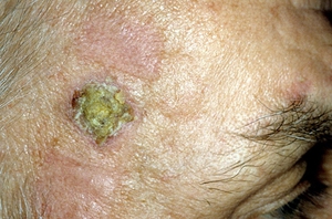 Плоскоклеточный рак кожи.