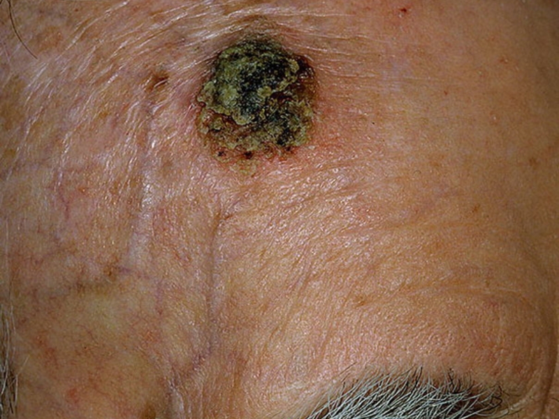 Принципы лечения плоскоклеточного рака кожи