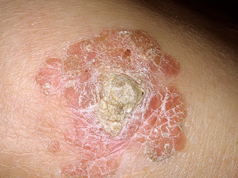 Развитие болезни плоскоклеточного рака кожи