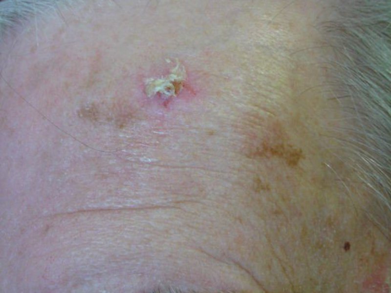 Какими методами лечат плоскоклеточный рак кожи