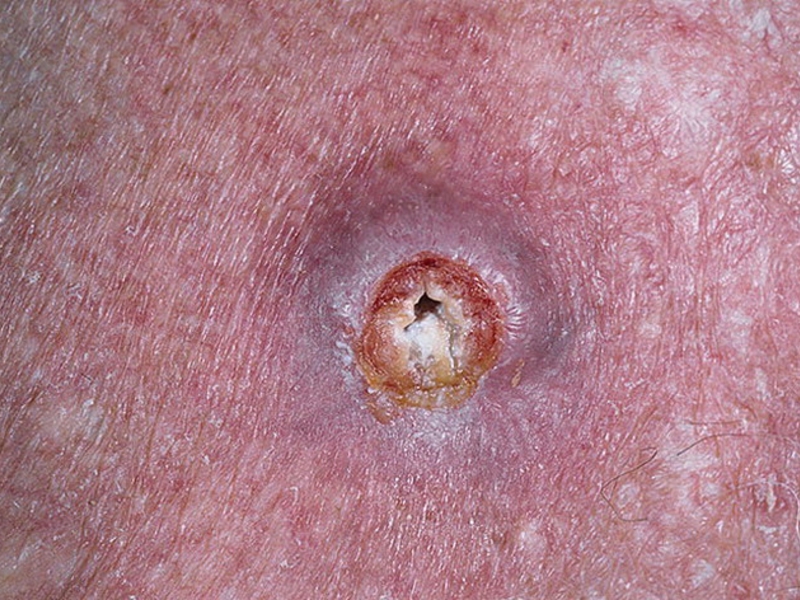 Этапы развития плоскоклеточного рака кожи