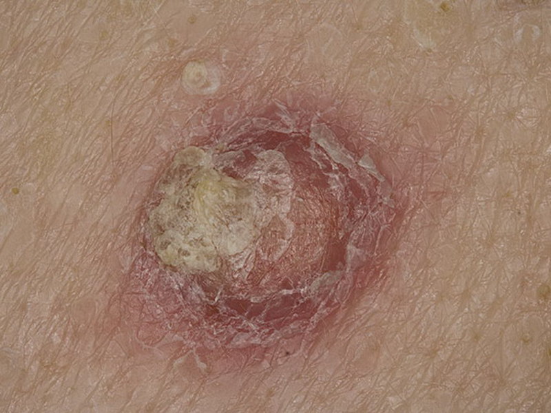 Проявление болезни плоскоклеточный рак кожи