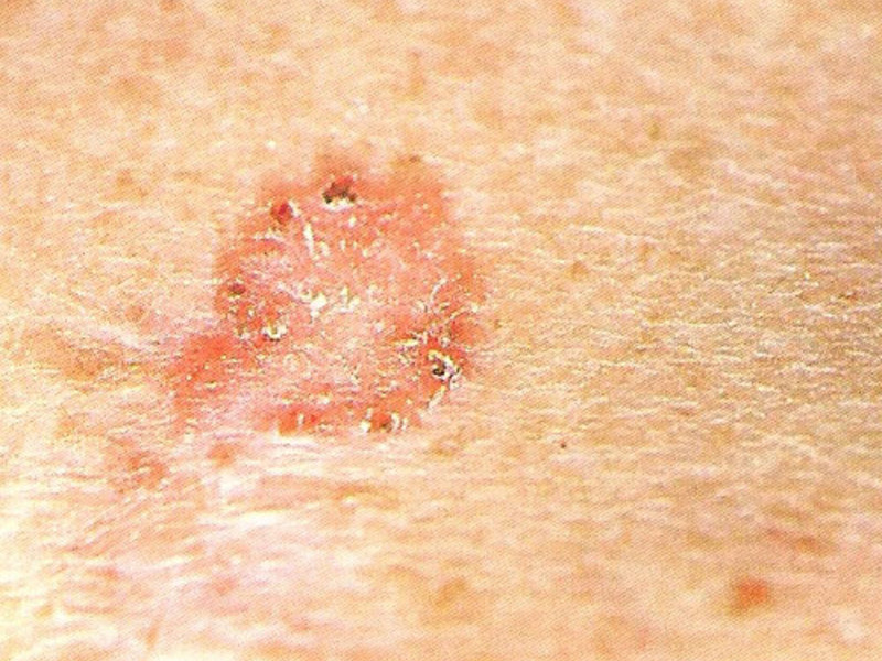 Причины возникновения плоскоклеточного рака кожи