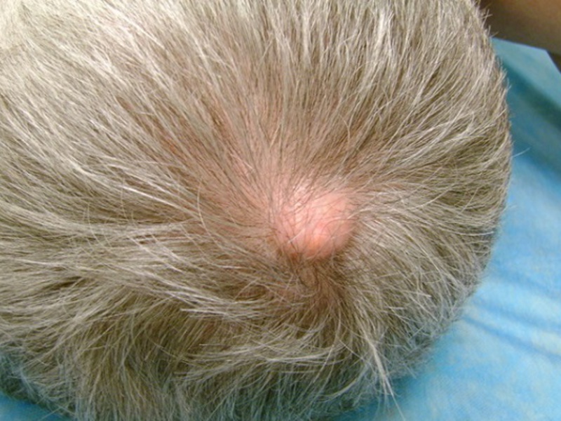 Атерома на волосистой части головы