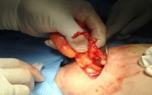 Липома молочной железы удаляется хирургическим путем.