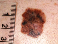 Меланома - на фото показана начальная стадия болезни.
