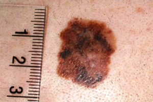Меланома - на фото показана начальная стадия болезни.