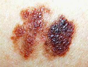 Поверхностная меланома на коже - один из самых частых вариантов заболевания.