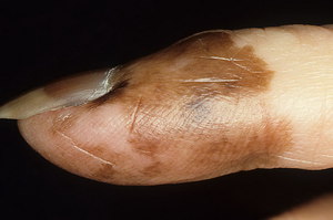 Акролентигинозная меланома - это образование под ногтями.