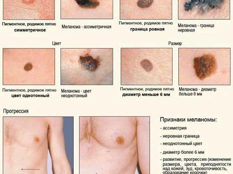 Рак кожи - как он проявляется?
