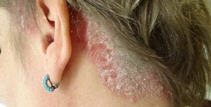 Псориатическая сыпь на волосяной части головы