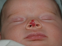 Как проявляется гемангиома у новорожденных