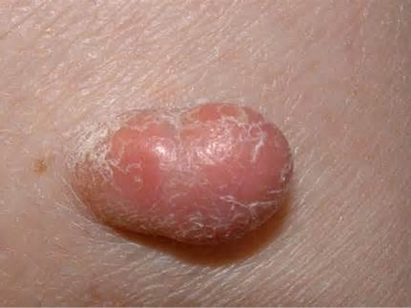 Фиброзная гистиоцитома - еще один вид образования на коже.