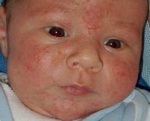 Стрептодермия на коже ребенка
