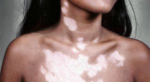 Как вылечить кожу от белых пятен