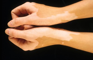 Заболевание кожи