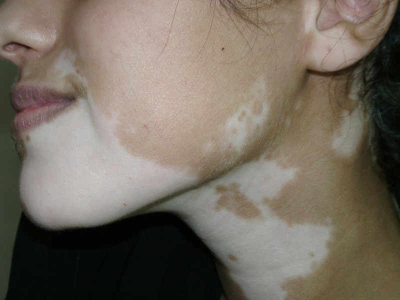 Симптомы заболевания кожи