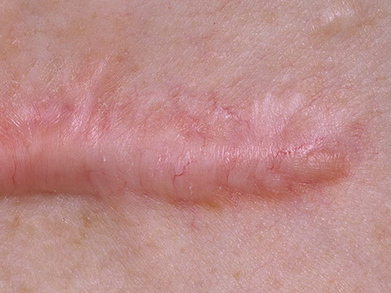 Методика лечения шрамов и рубцов