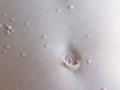 Контагиозный моллюск на коже у ребнка симптомы диагностика лечение