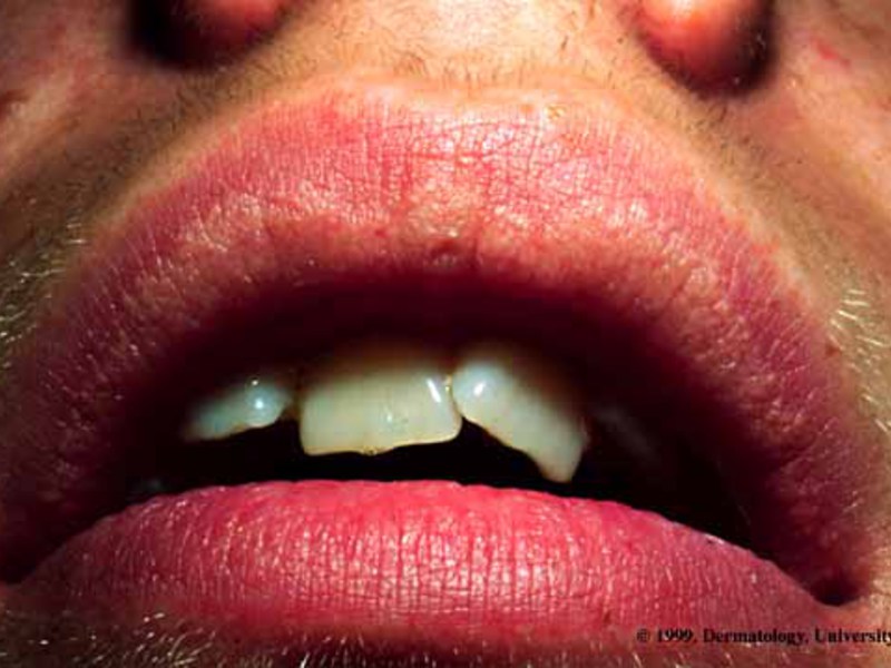 Как вылечить губы от гранул Фордайса 