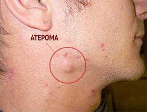 Атерома - особенности заболевания.