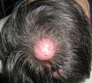 Атерома расположена на волосистой части головы.