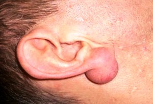 Атерома на ухе - фото пациента.