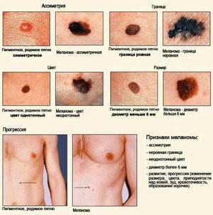 Стадии развития рака кожи показаны на рисунке.