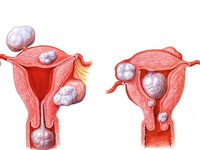 Современная диагностика фибромы матки
