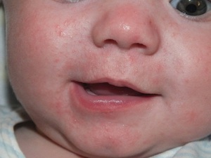 Cыпь на лице у малышей может появиться по разным причинам.