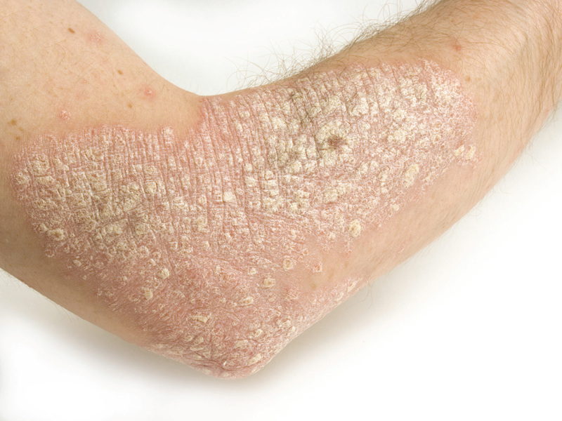 Методы лечения кожи локтей 
