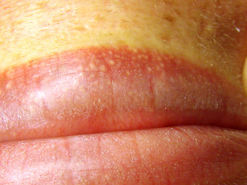 Методы лечения губ от белых точек