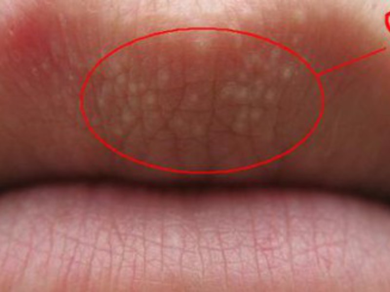 Почему появляются точки на губах