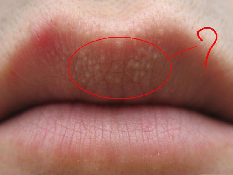 Чем вывести белые точки на губах