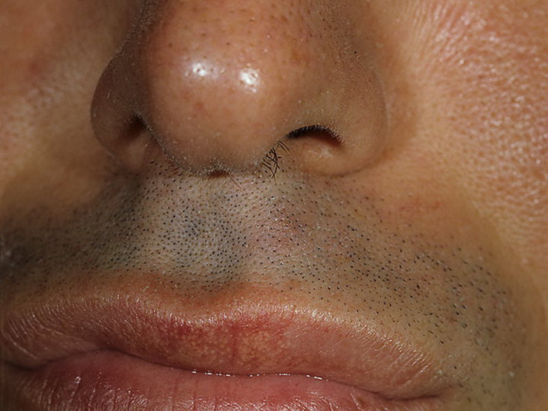 Как устранить точки на губах