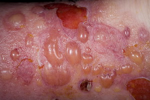 Какие симптомы у буллезного дерматита
