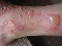 Симптомы буллезного дерматита