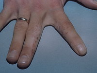 Как проявляется заболевание дисгидроз кистей рук