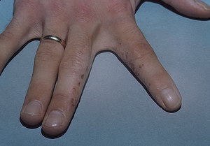 Как проявляется заболевание дисгидроз кистей рук