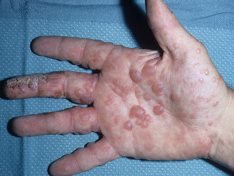 Причины появления заболевания дисгидроз кистей рук