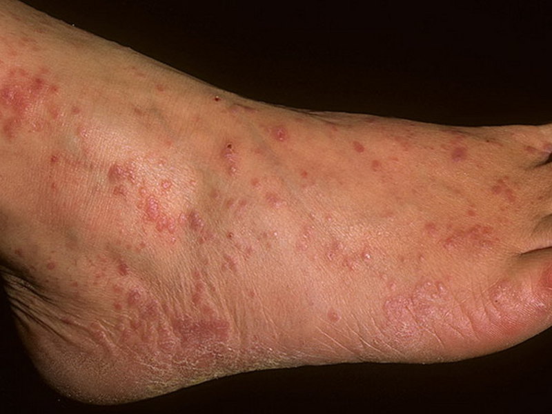 Красный плоский лишай: лечение, симптомы и фото заболевания