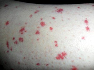 Как лечиться рак кожи