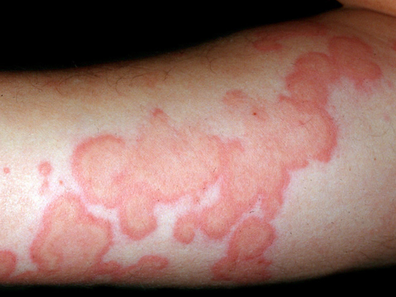 Как выглядит аллергия на нервной почве