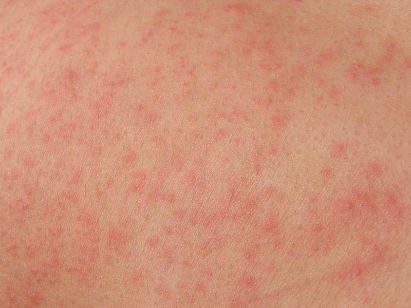Как проявляется аллергия от нервов