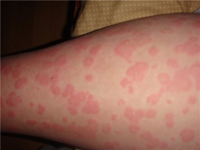 Как проявляется аллергия на кожных покровах на нервной почве