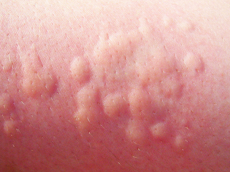 Аллергия на руке от нервов