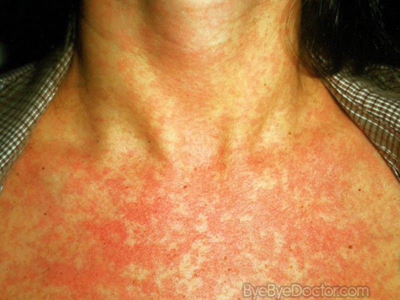 Различные проявления аллергии на кожных покровах