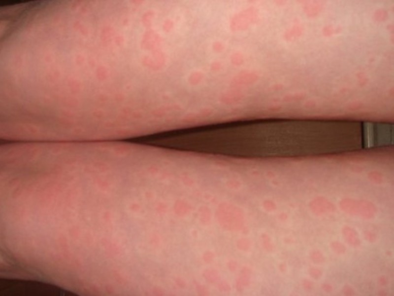 Как проявфляются симптомы аллергии на нервной почве