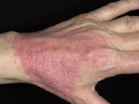 Контактный дерматит возникает от соприкосновения с аллергенами.